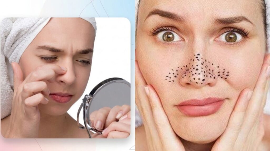 blackheads home remedies